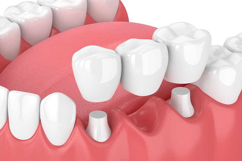 Dental Bridges in Newaygo