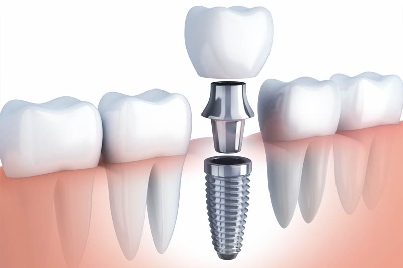 Implant Surgery in Newaygo